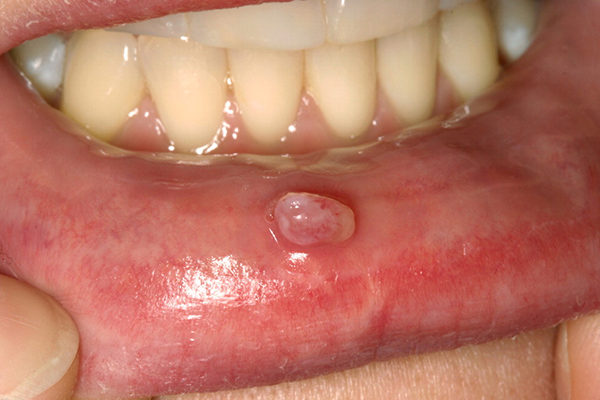 Oral Lesions Treatment