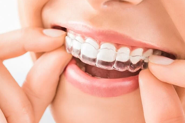 Invisible Braces / Aligners
